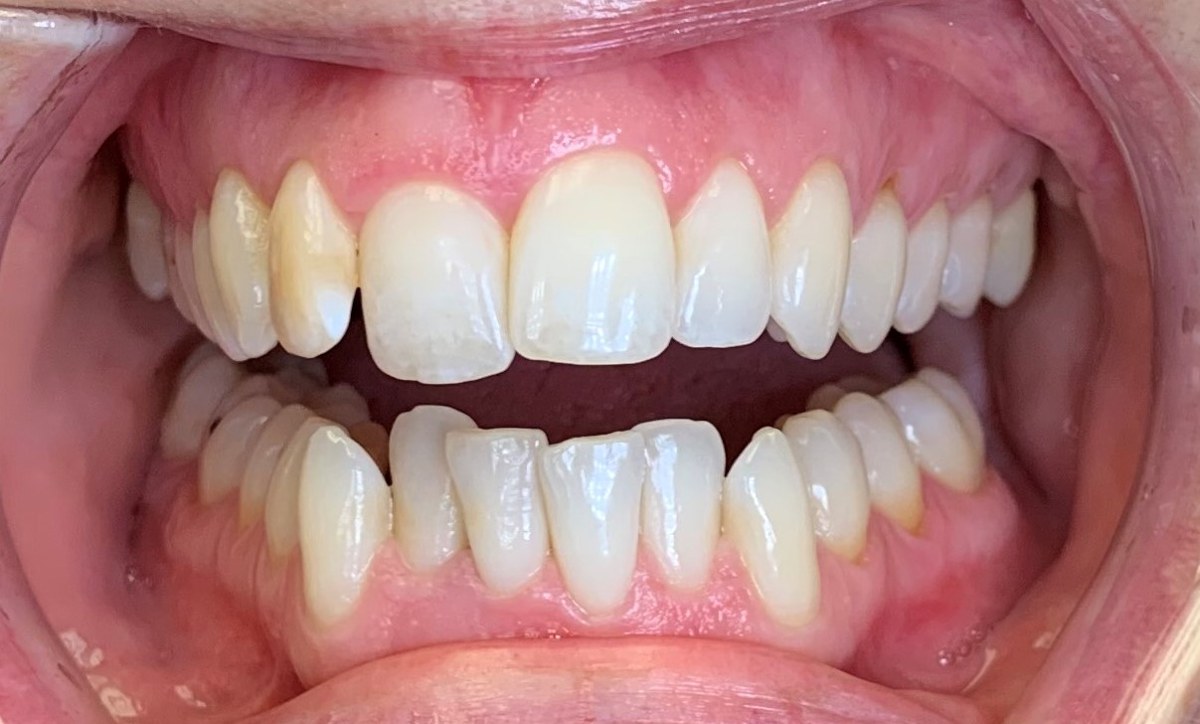 Case 1 before C5 treatment