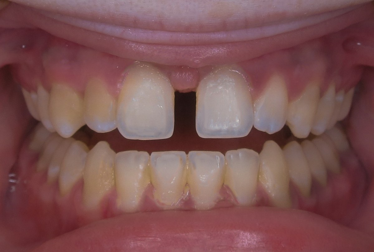 Case 2 before C5 treatment