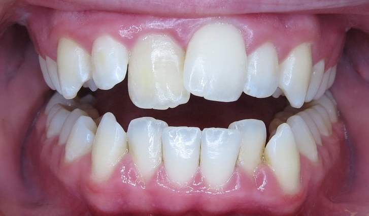 Case 3 before C5 treatment