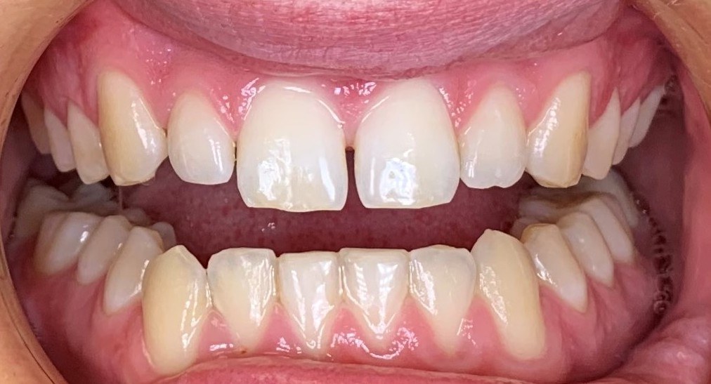 Case 4 before C5 treatment